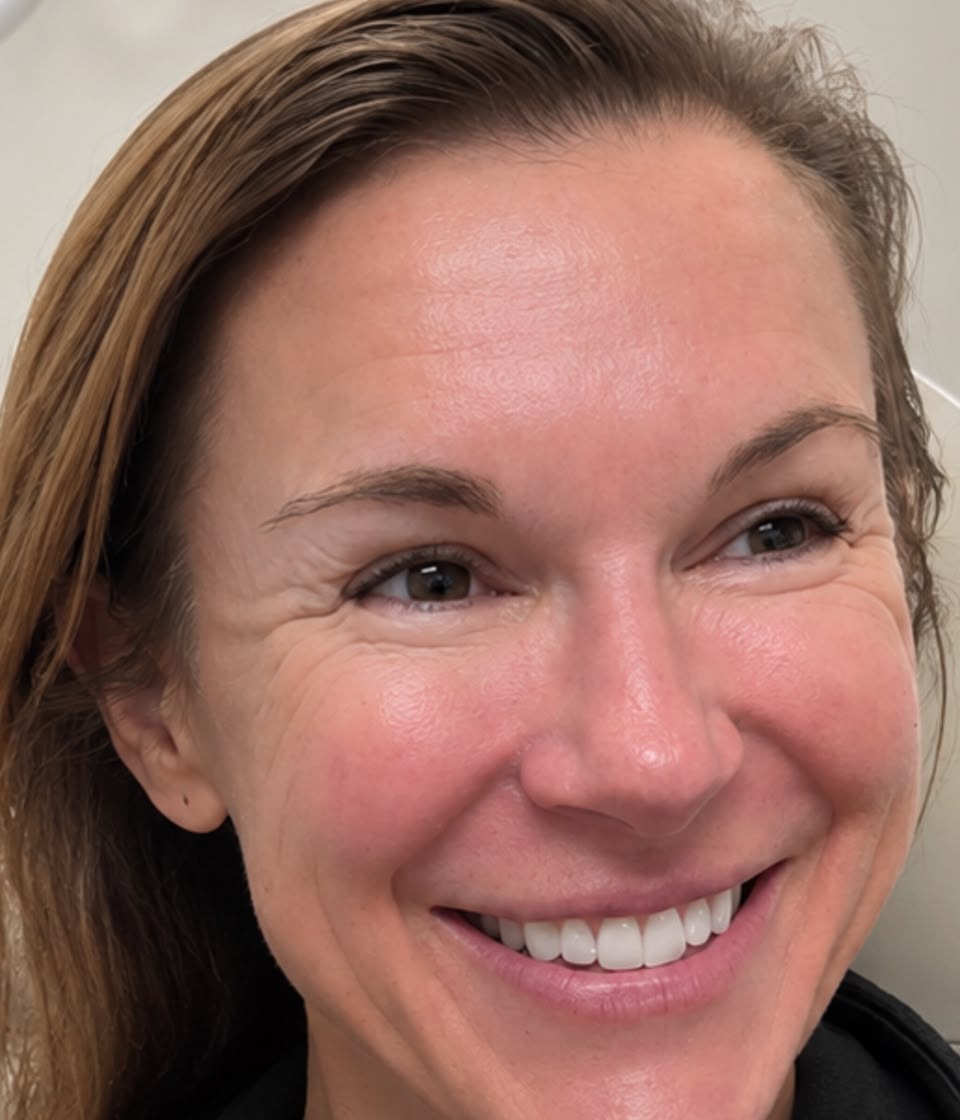 Botox, Crow's Feet, before