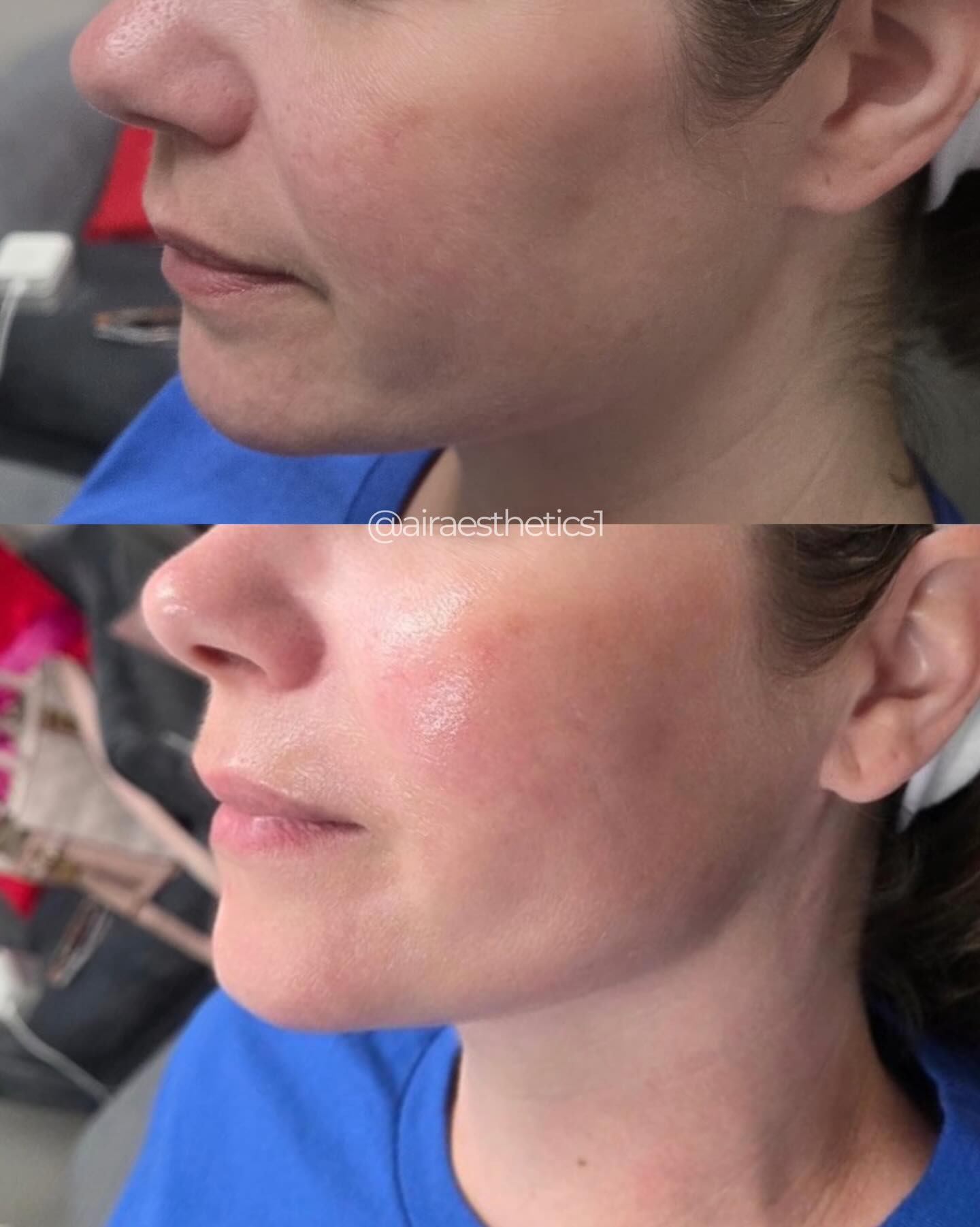 Cheek filler — subtle volume — AIR Aesthetics, Mankato MN