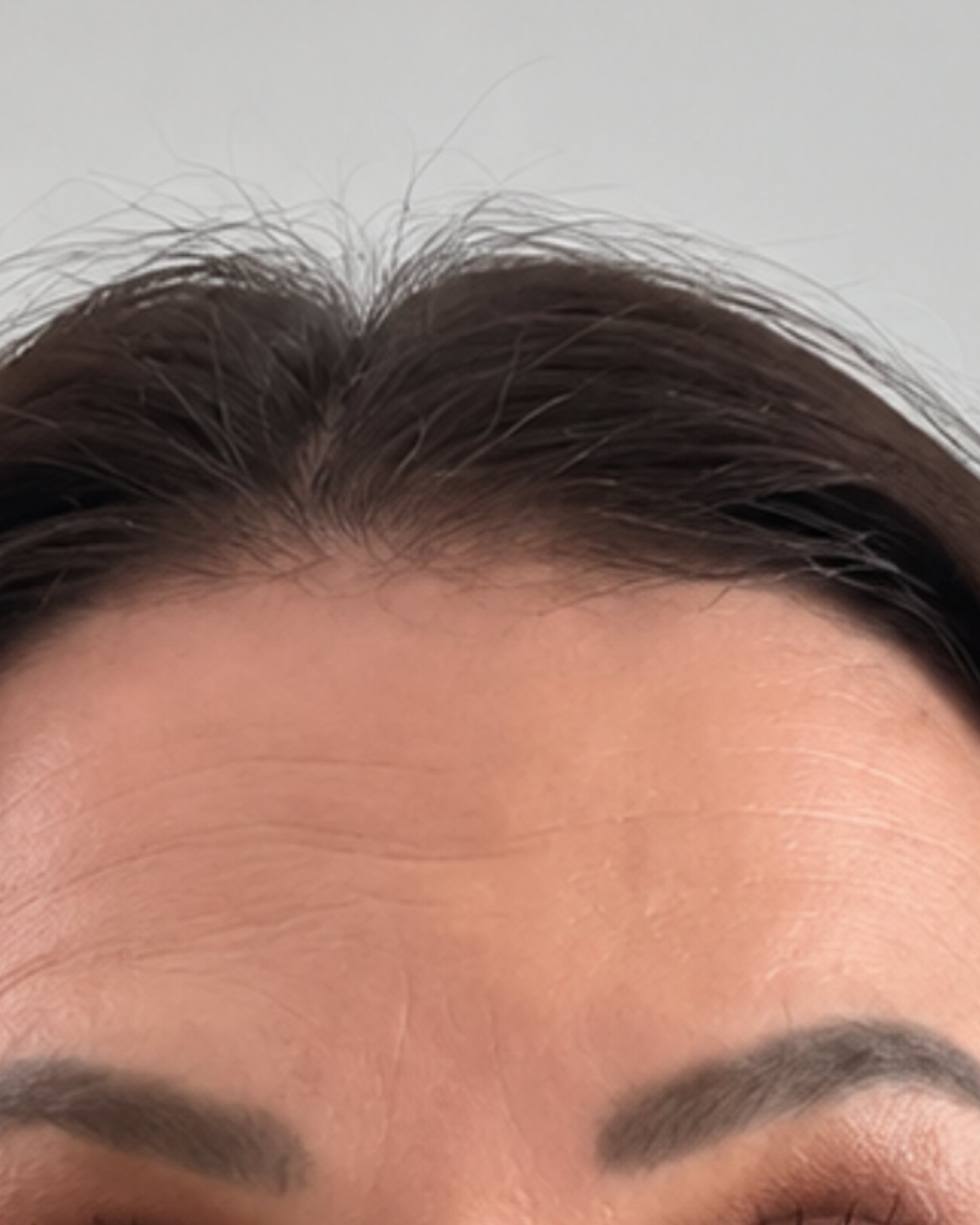 Daxxify, Forehead Lines, after