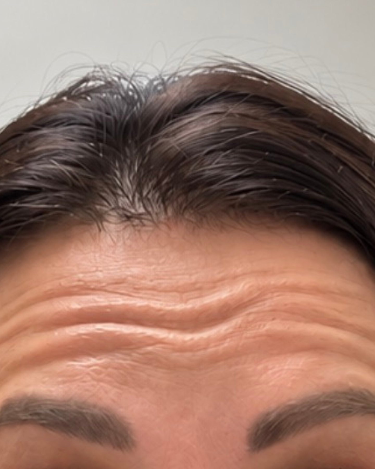 Daxxify, Forehead Lines, before