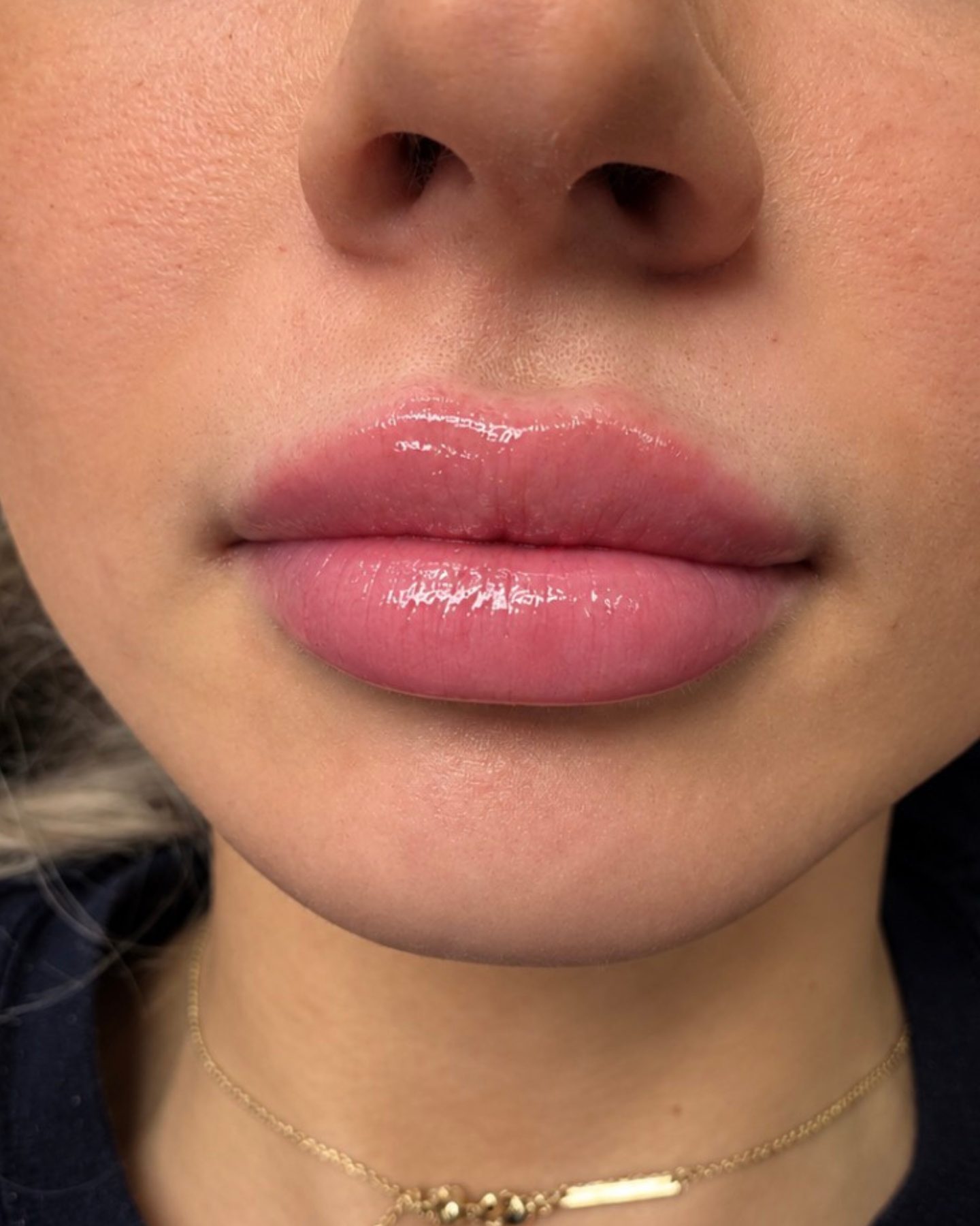 Lip Filler, after