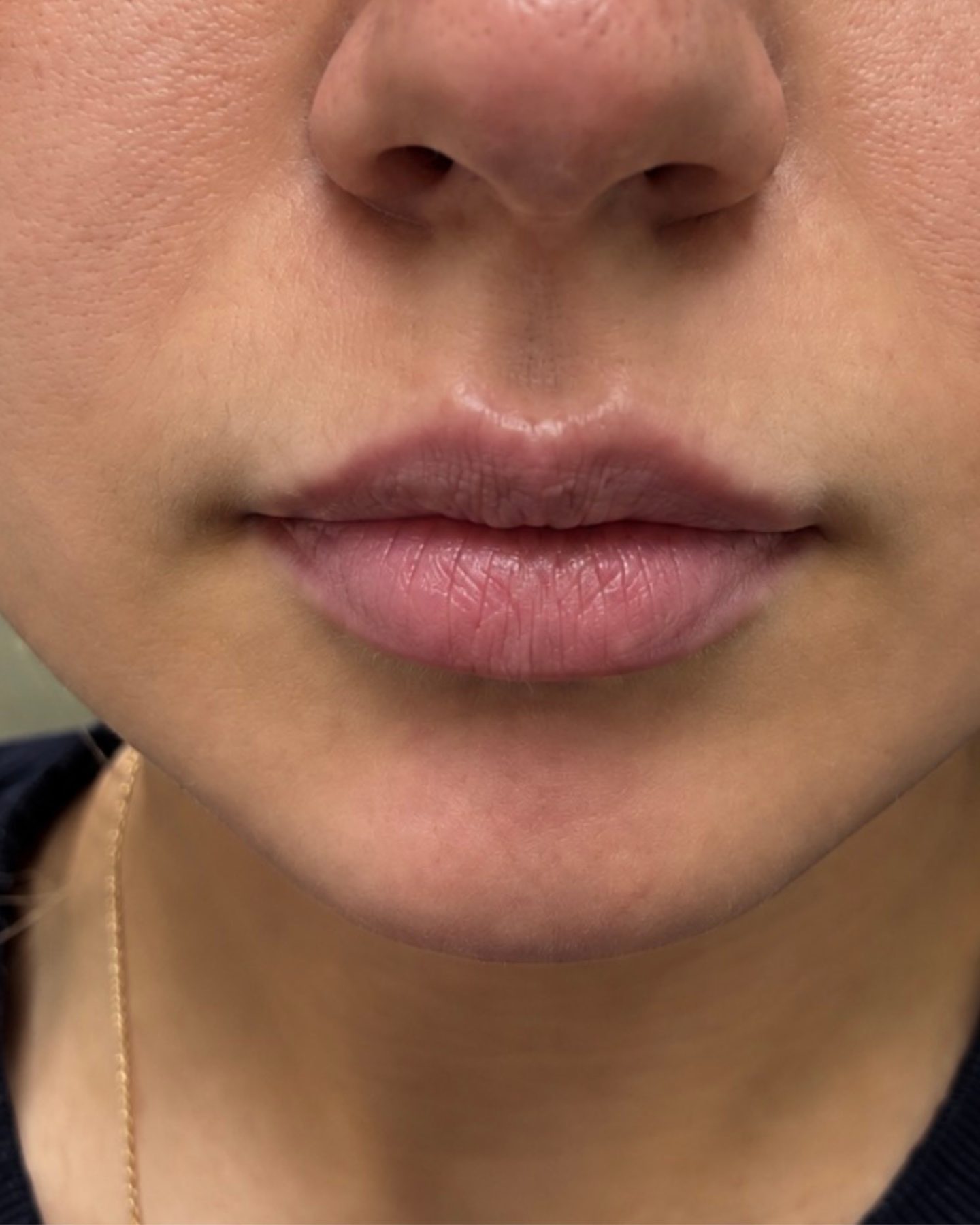 Lip Filler, before