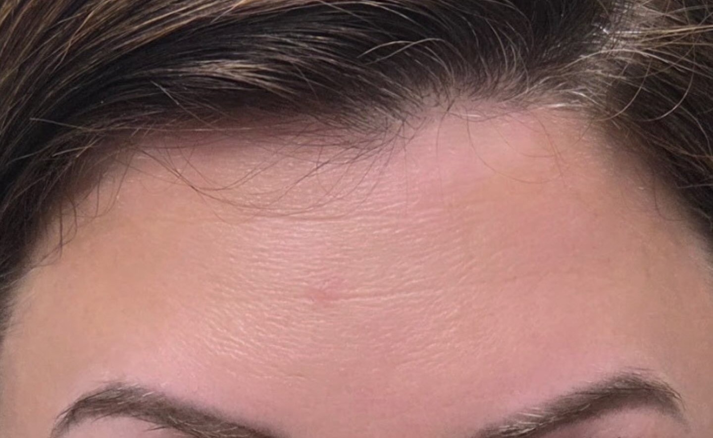 Real Botox result, Mankato MN