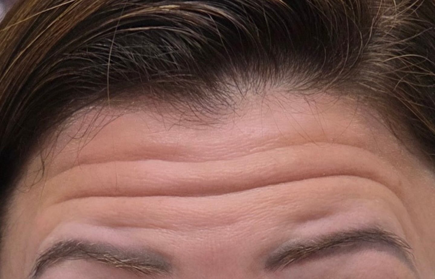 Forehead Botox, before