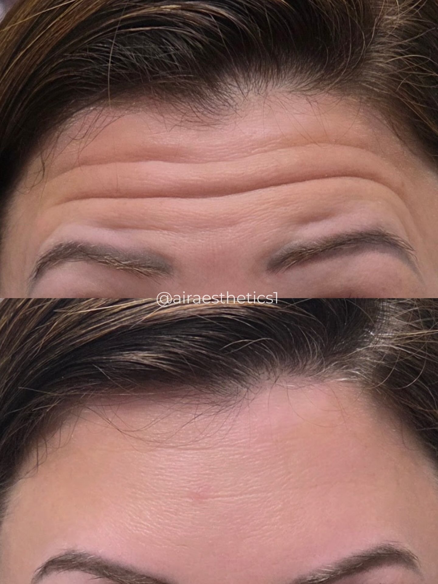 Forehead Botox — before & after — AIR Aesthetics, Mankato MN