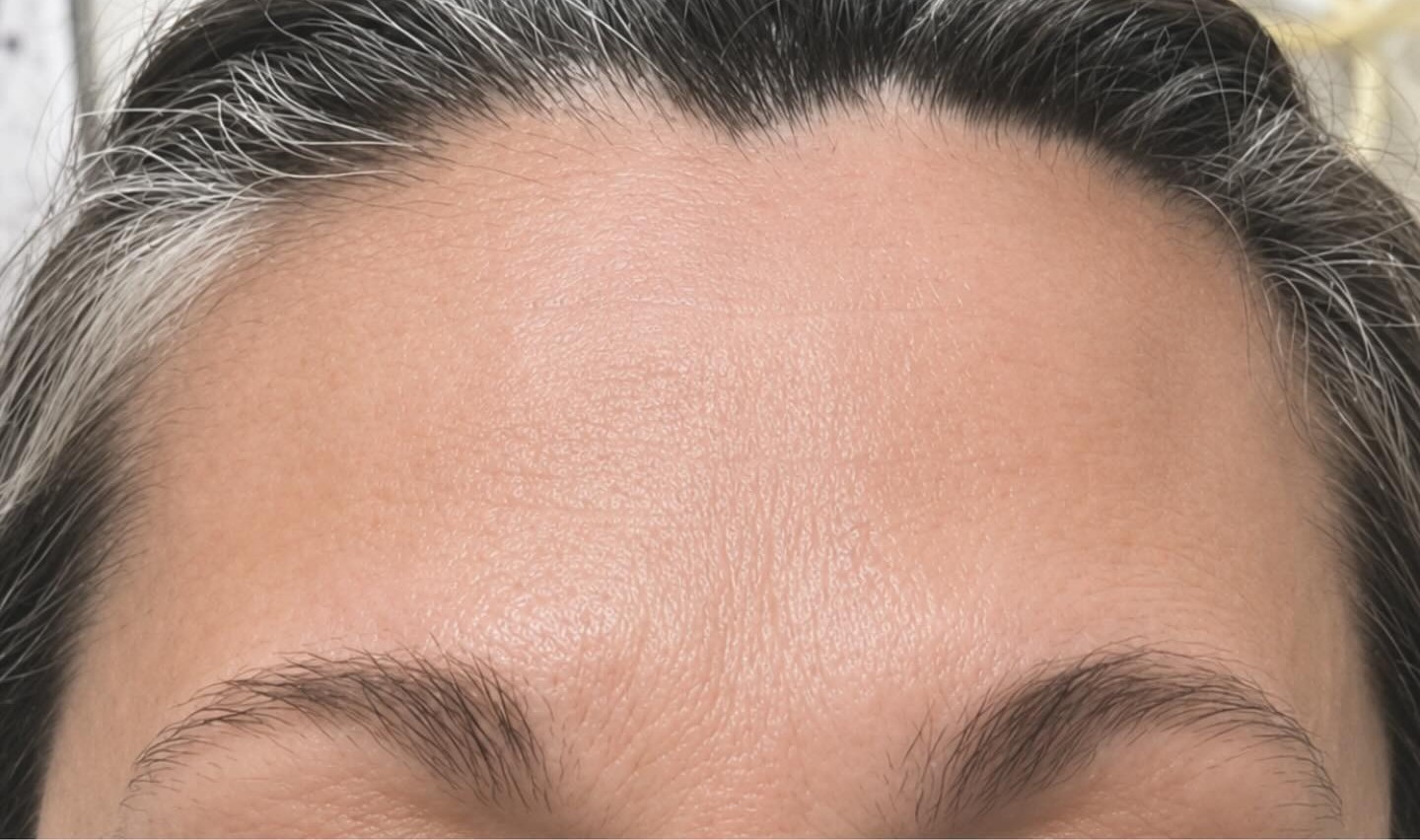 Forehead Botox, Frown Lines, after