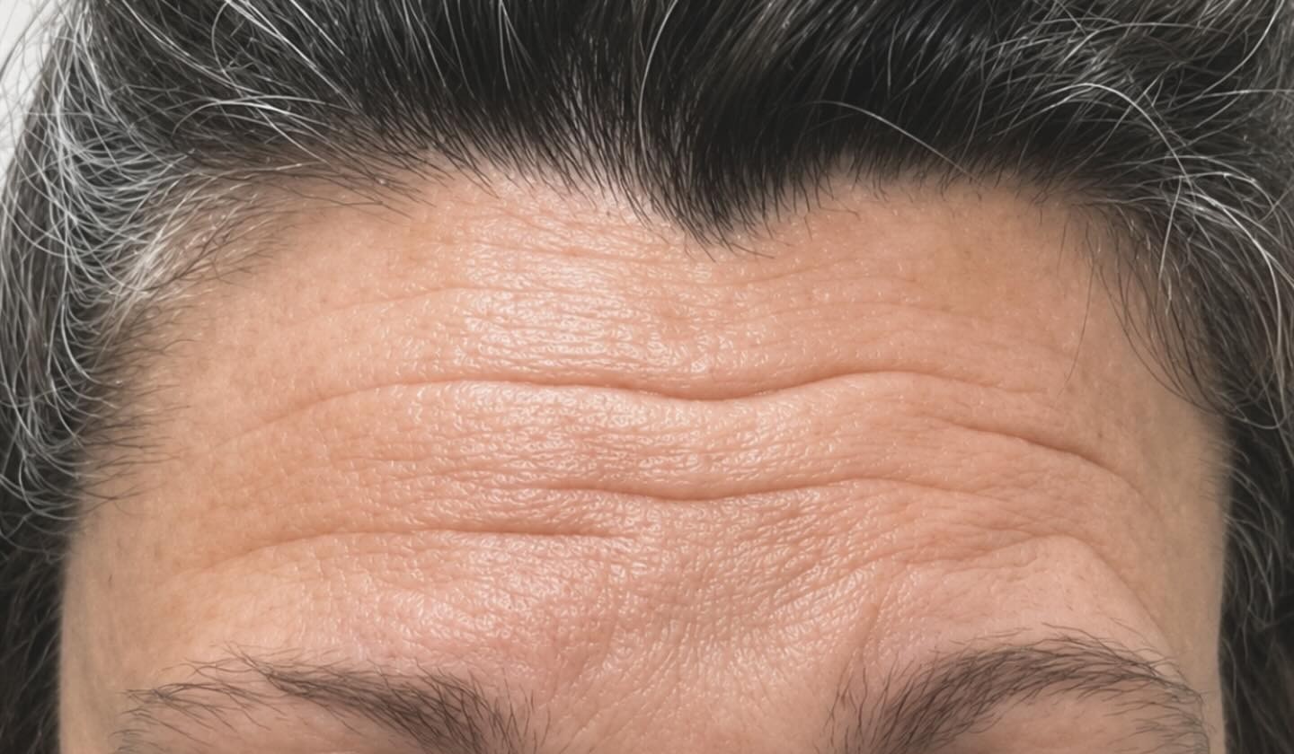 Forehead Botox, Frown Lines, before