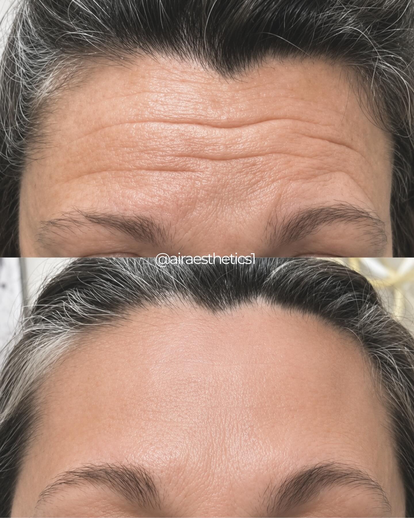Forehead Botox — frown lines smoothed — AIR Aesthetics, Mankato MN
