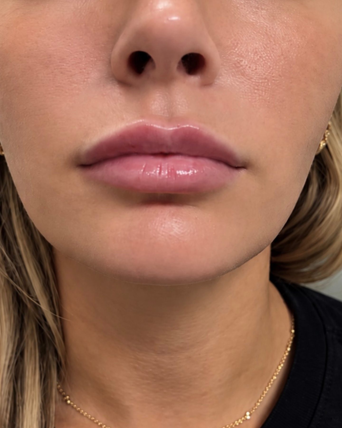 Lip Enhancement, after
