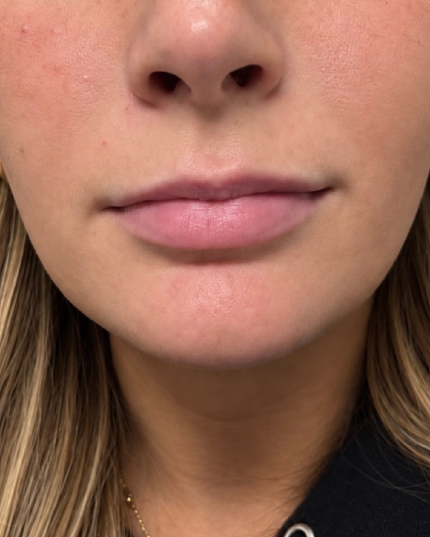 Lip Enhancement, before