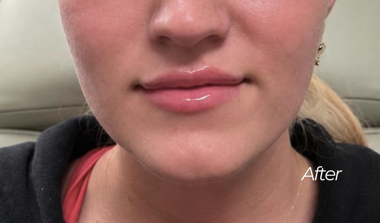 Lip Enhancement, after