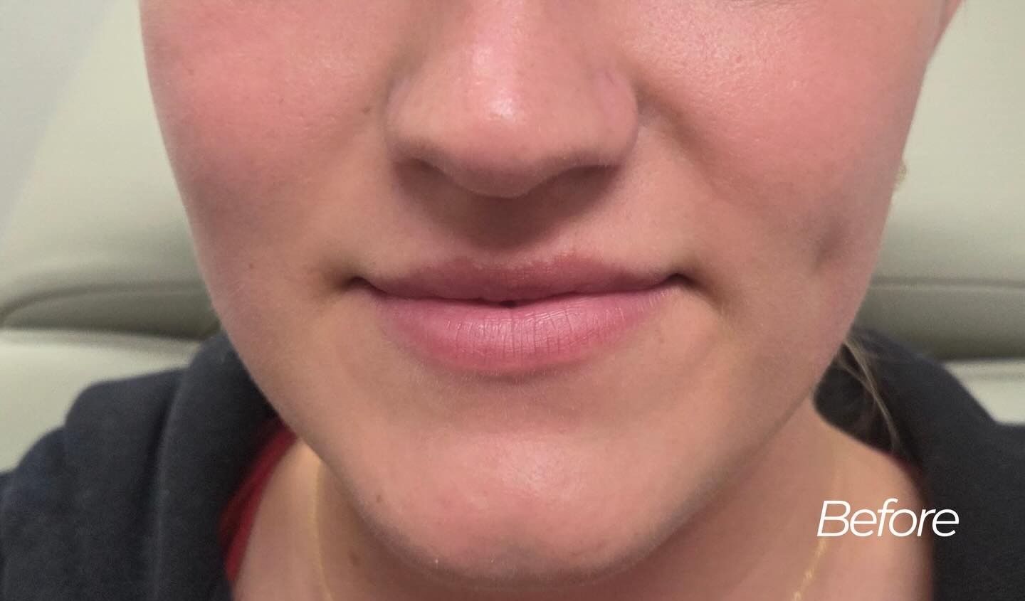 Lip Enhancement, before