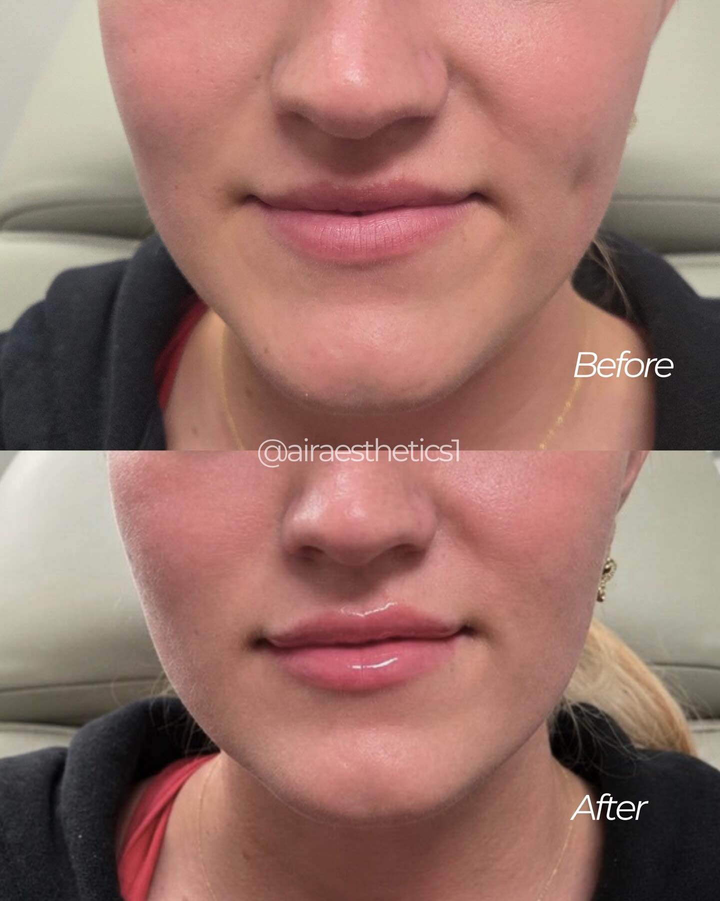 Lip filler — before & after — AIR Aesthetics, Mankato MN