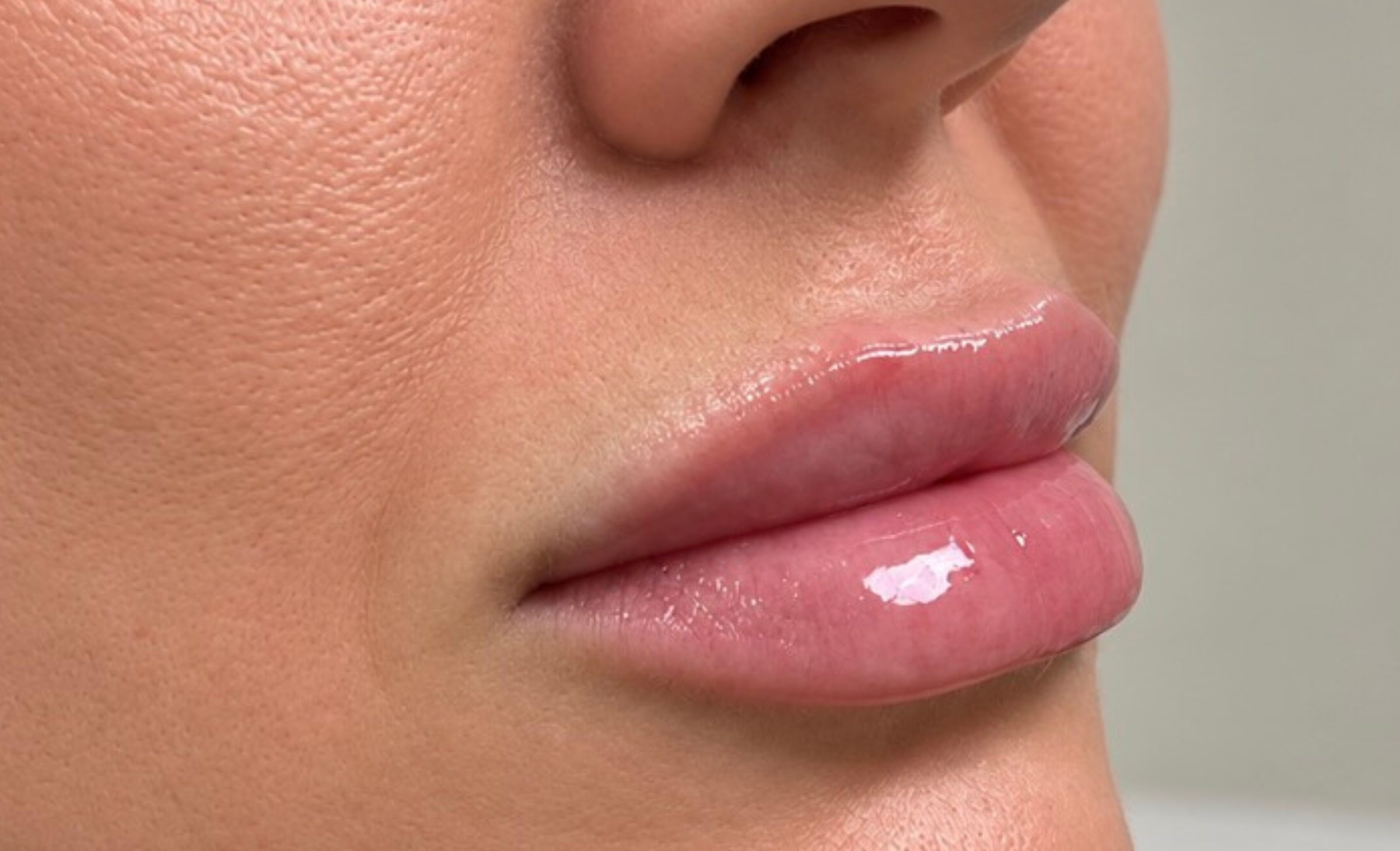 Close-up of a natural lip filler result at AIR Aesthetics in Mankato, MN