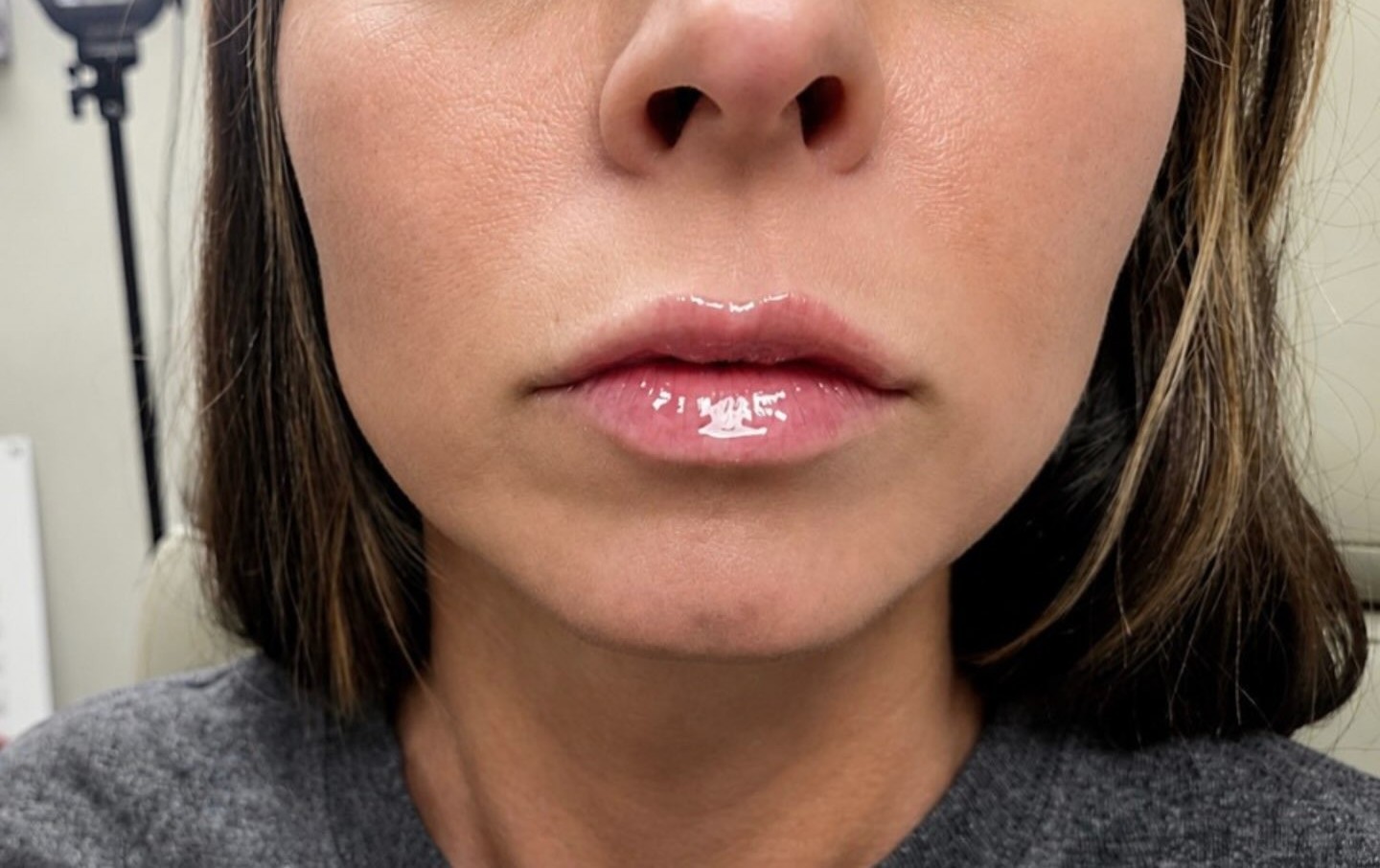 Lip Filler, after