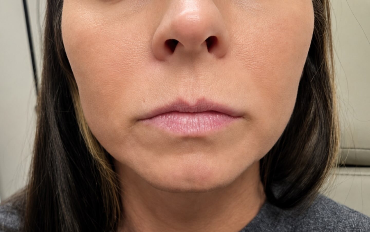 Lip Filler, before