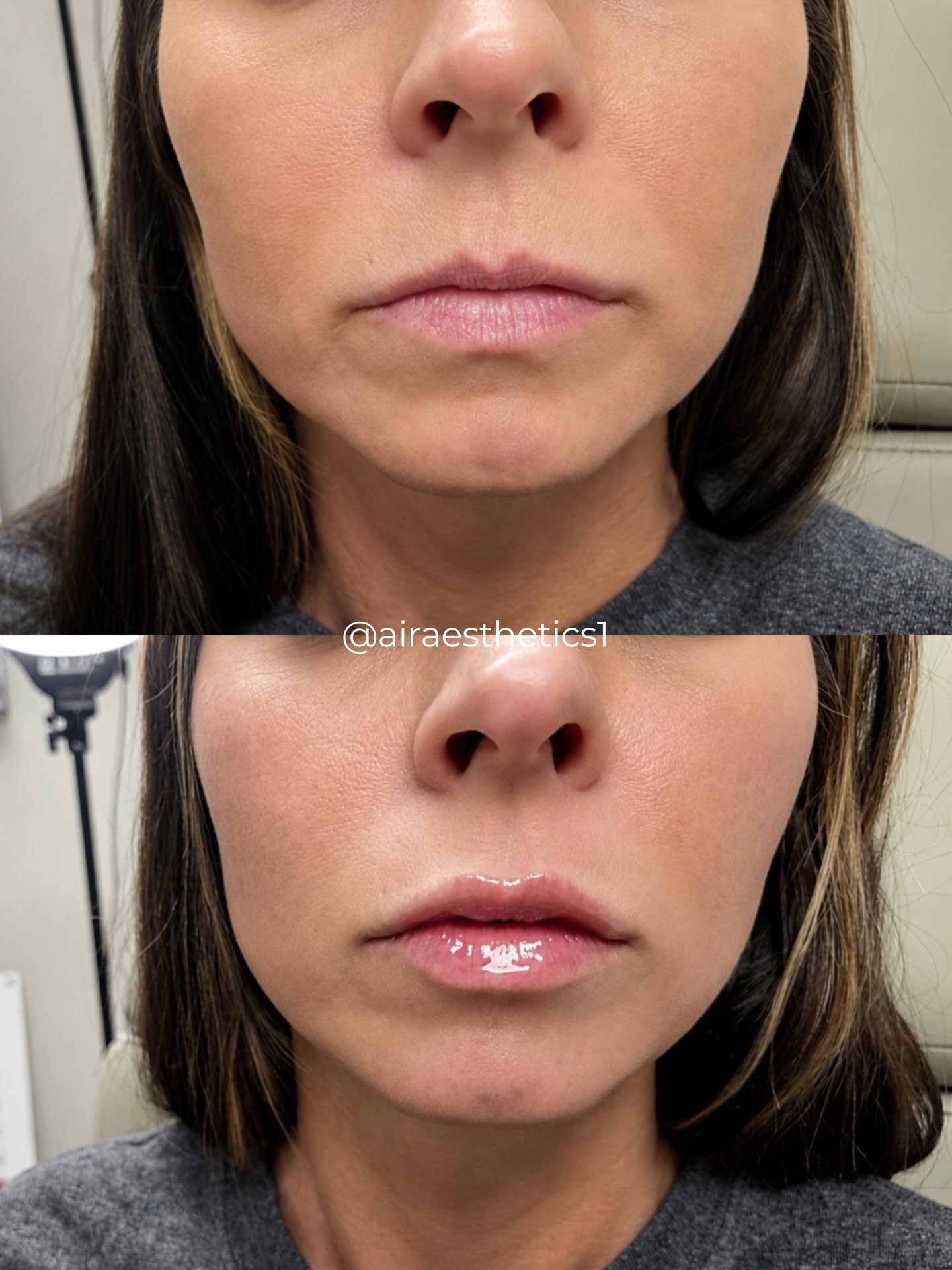 Lip filler — natural results — AIR Aesthetics, Mankato MN