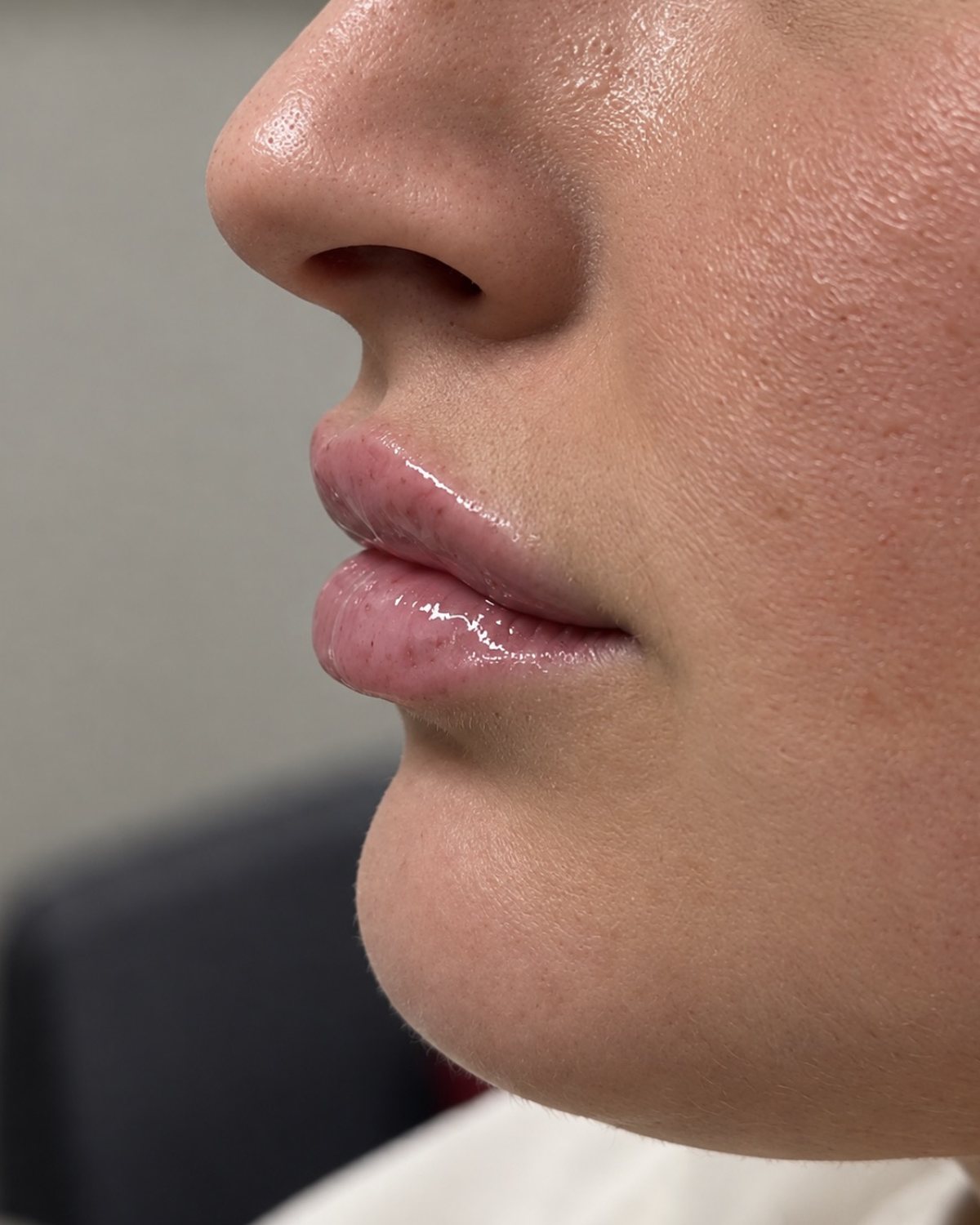 Lip Filler, Side Profile, after