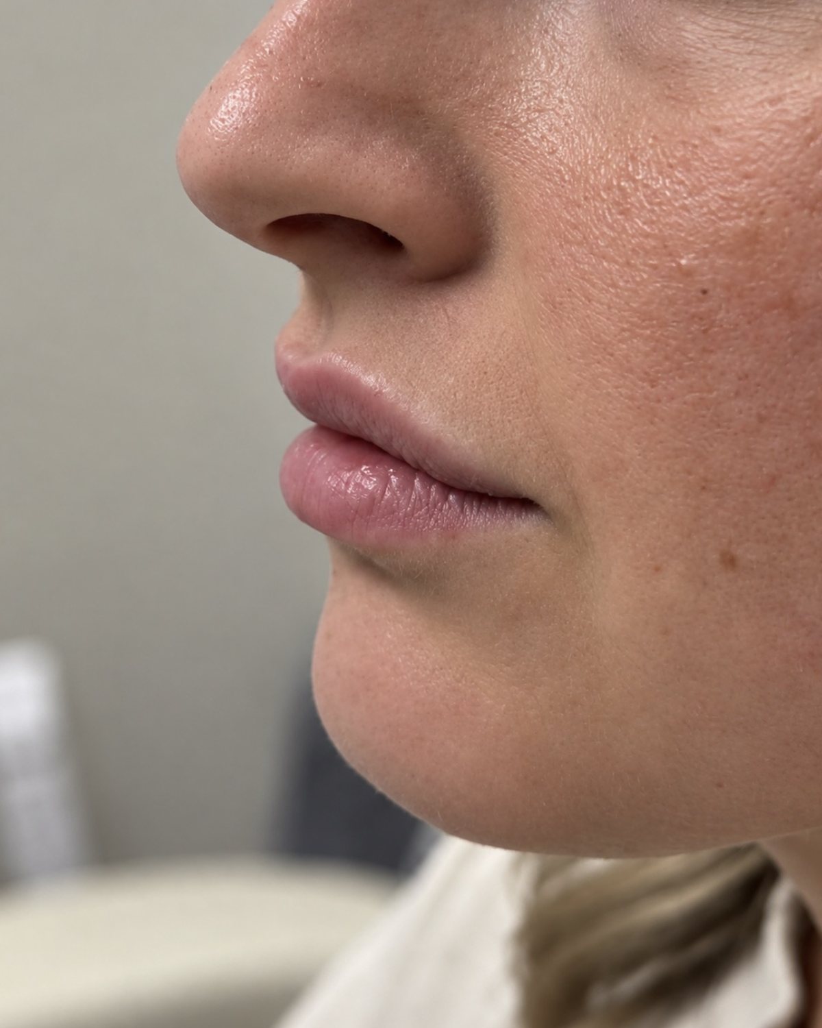 Lip Filler, Side Profile, before