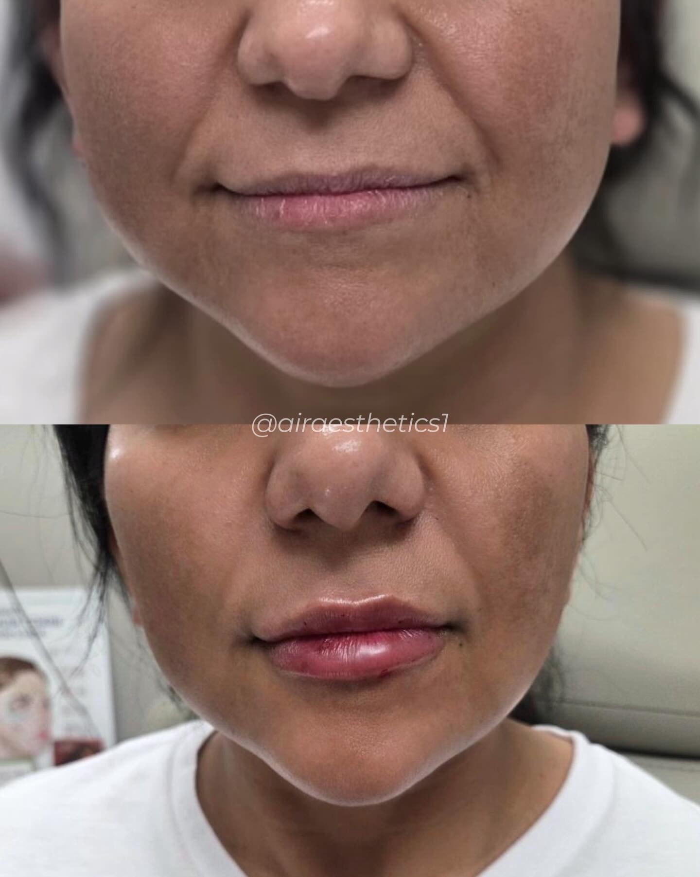 Lip filler — subtle enhancement — AIR Aesthetics, Mankato MN