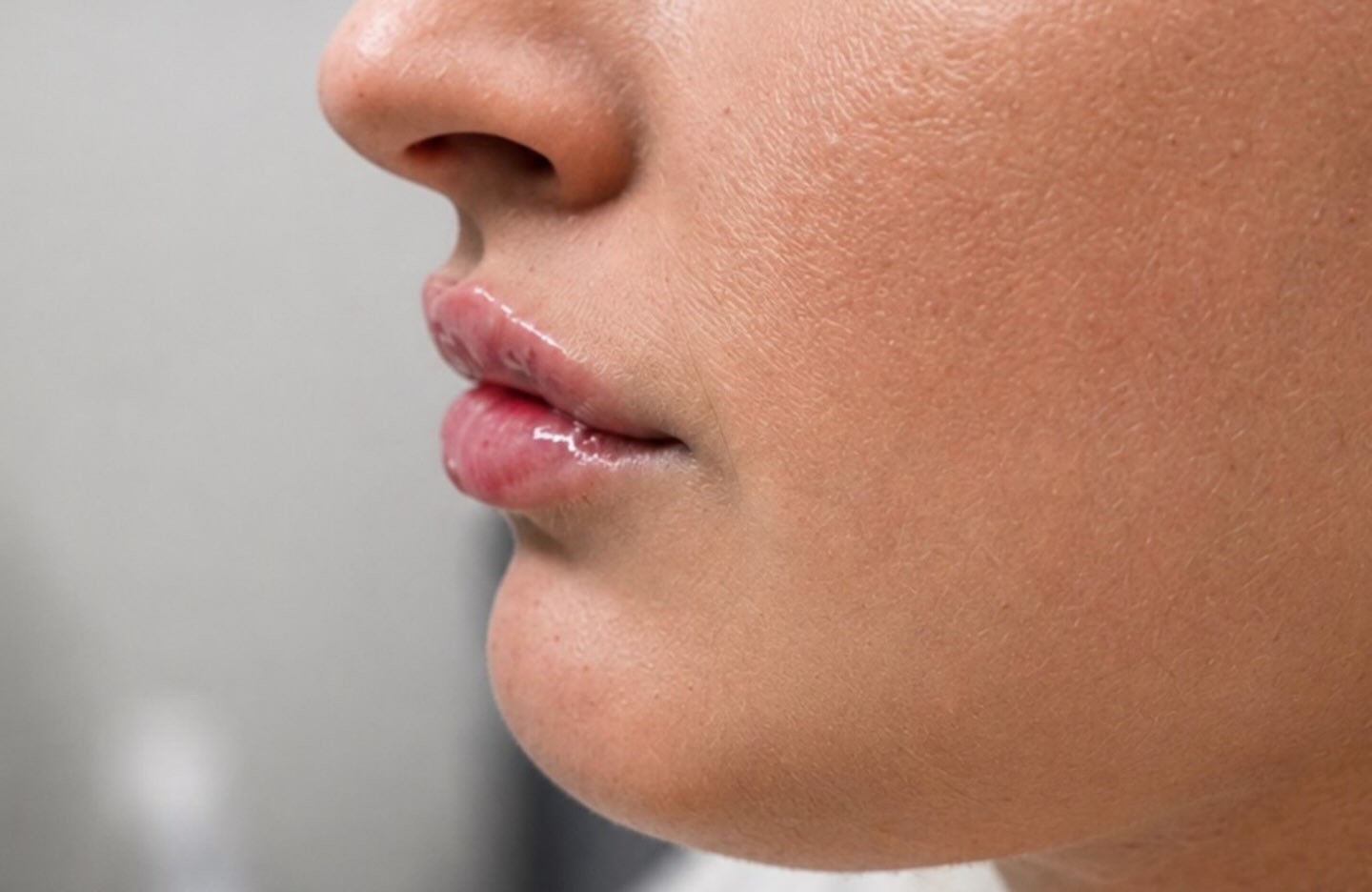 Lip Filler, Side Profile, after