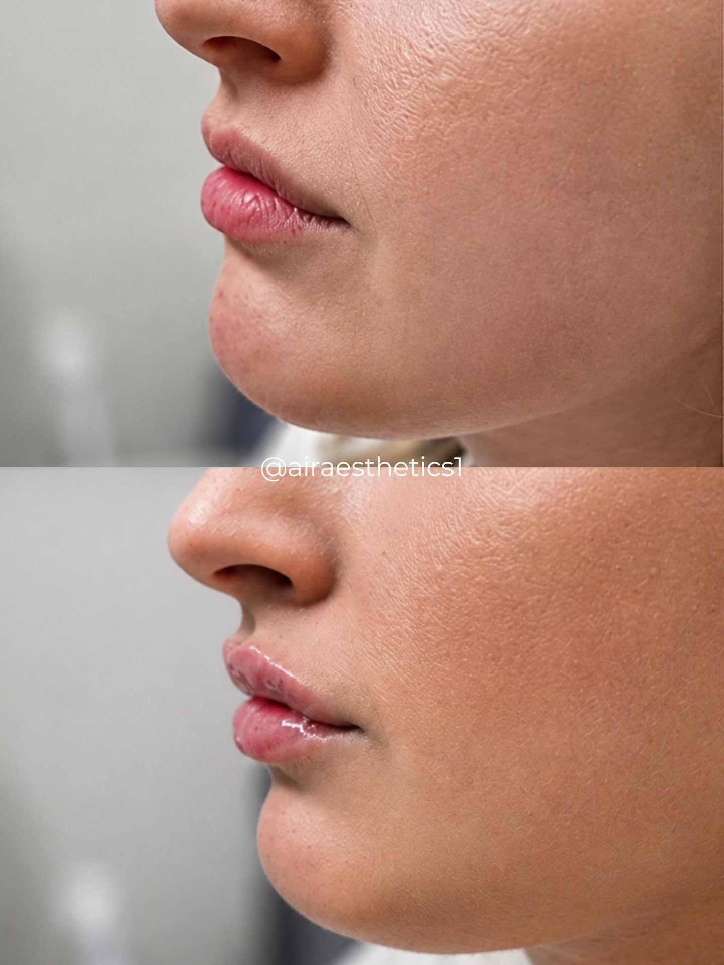Lip filler — side profile — AIR Aesthetics, Mankato MN