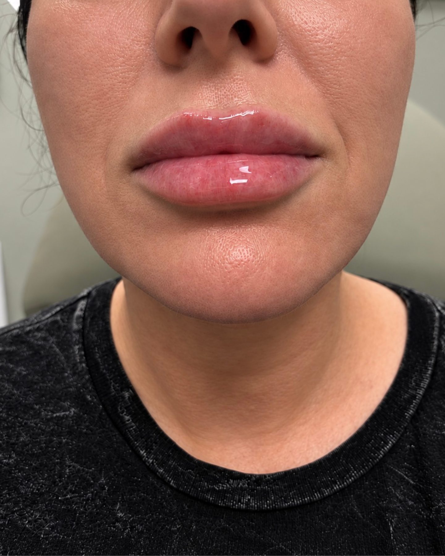 Real lip filler result, Mankato MN