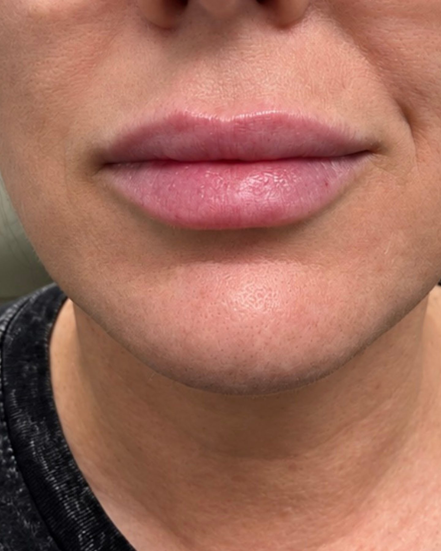 Lip Injections, Front View, before