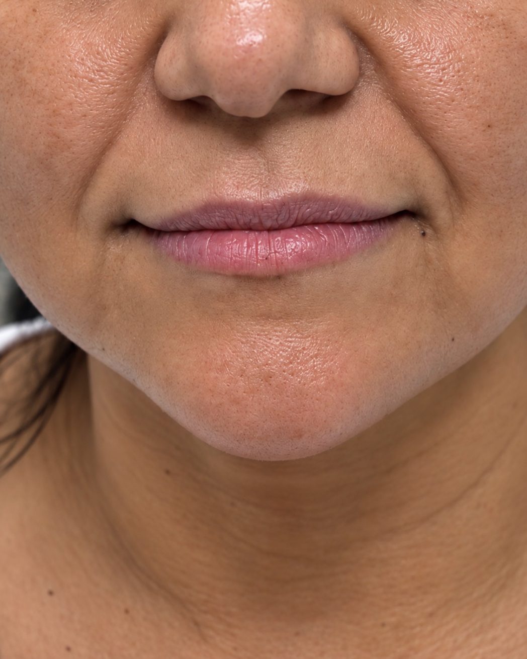 Lip Injections, Front View, before