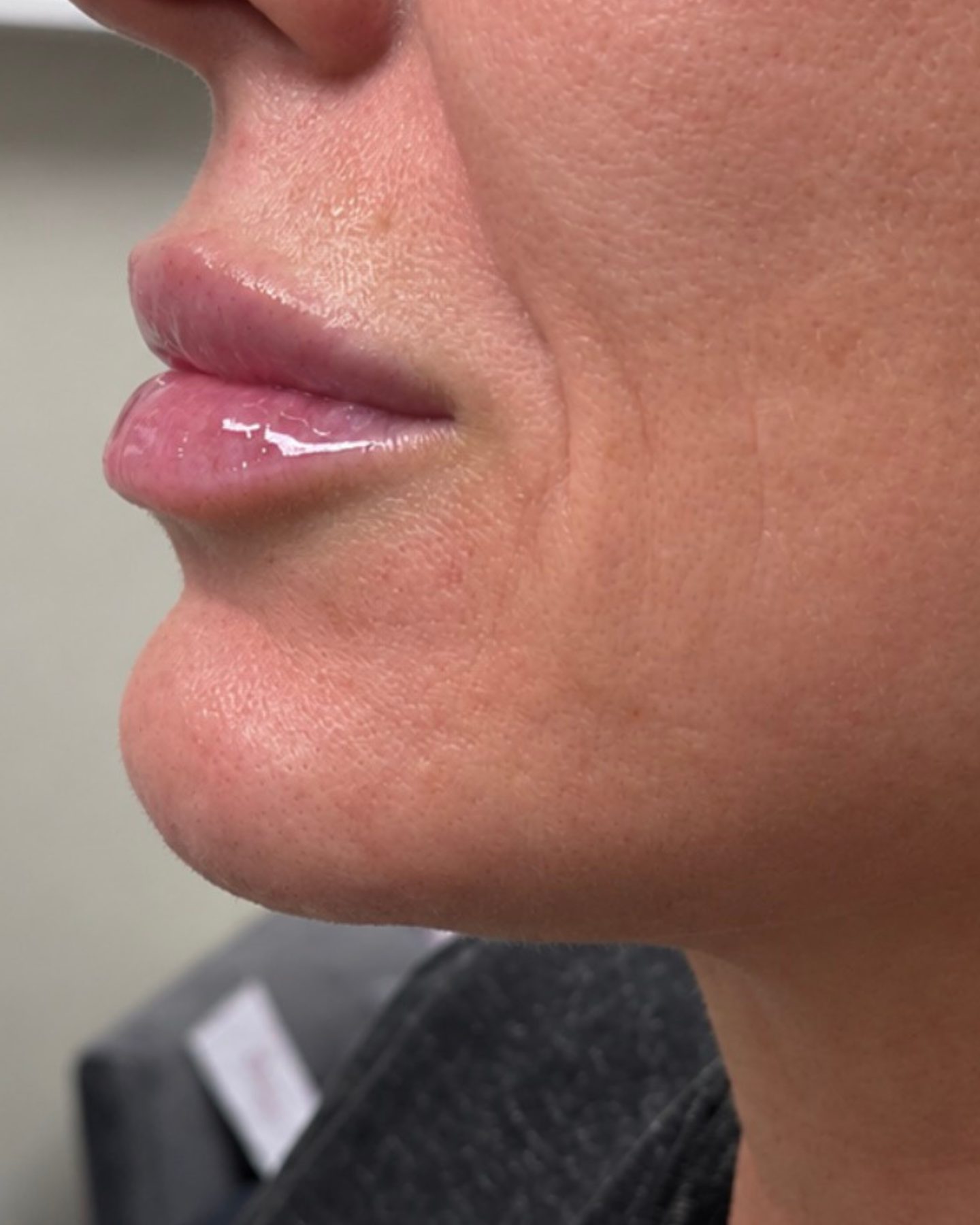 Natural Lip Filler, Profile, after