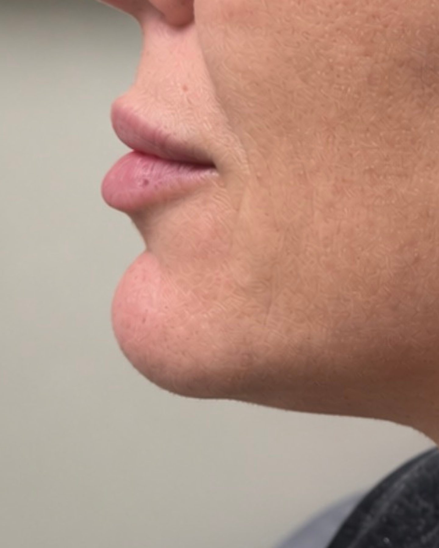 Natural Lip Filler, Profile, before
