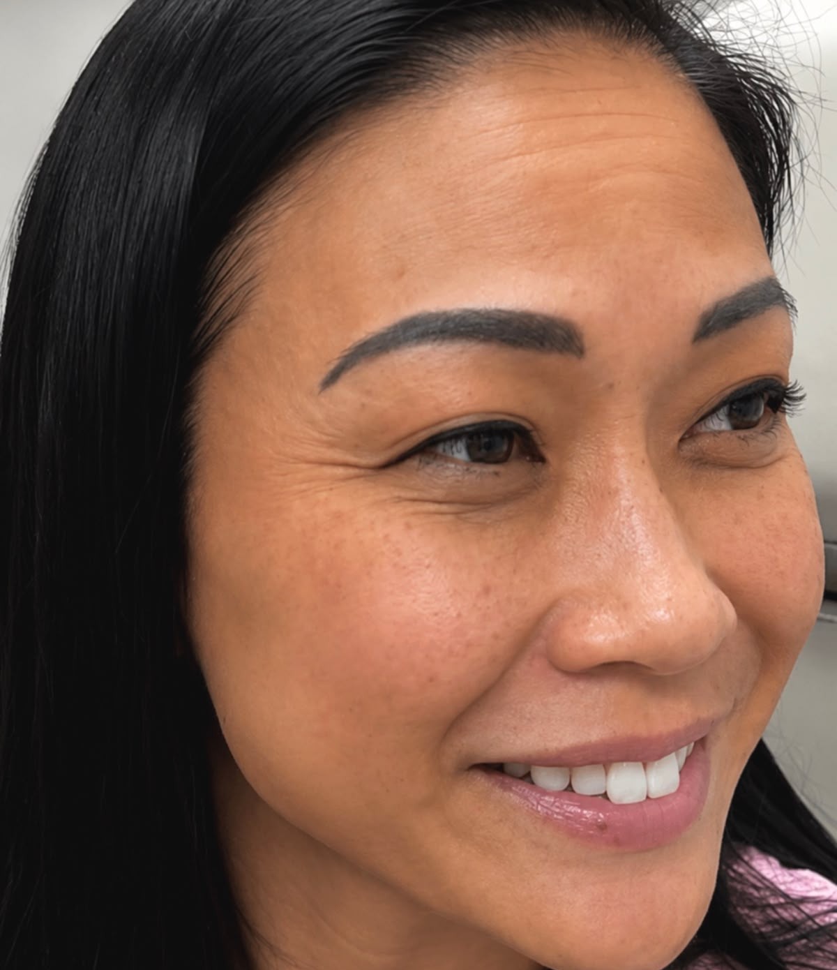 Xeomin, Crow's Feet, before