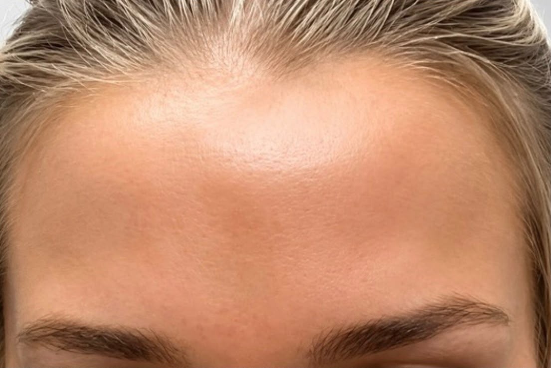 Xeomin, Forehead, after
