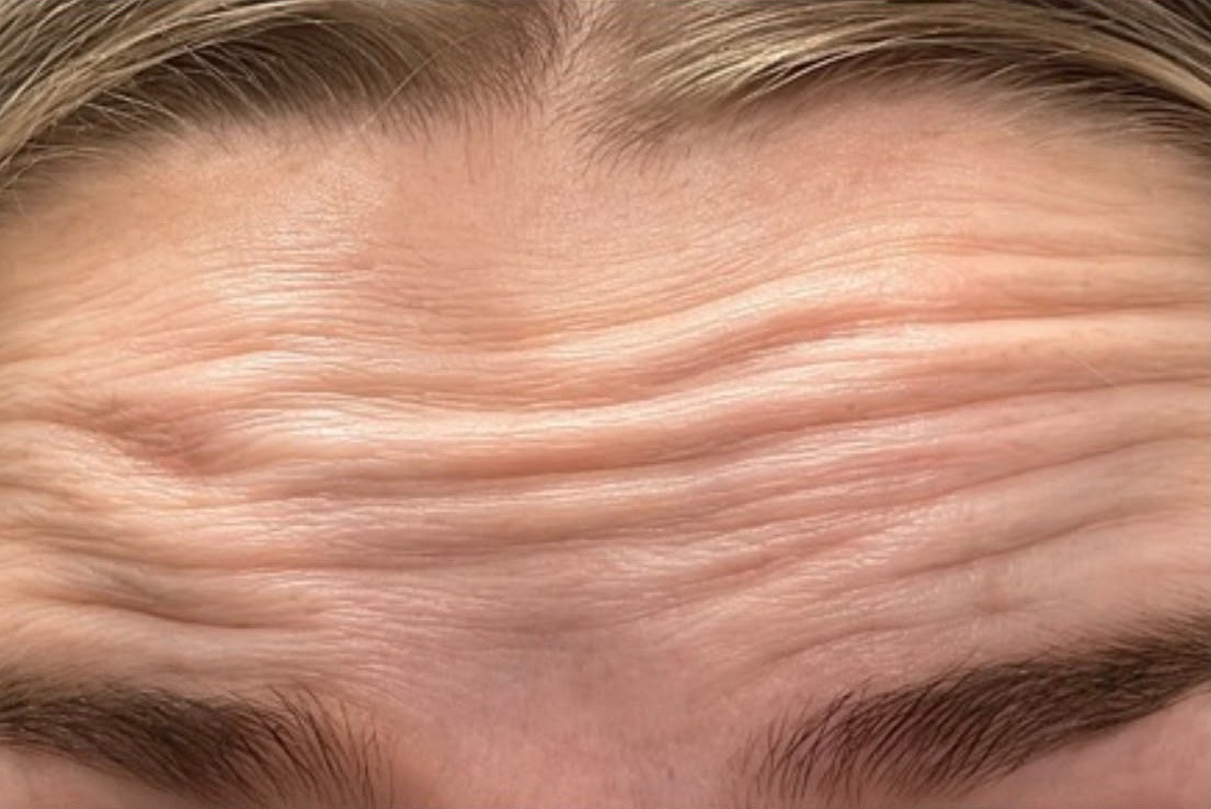 Xeomin, Forehead, before